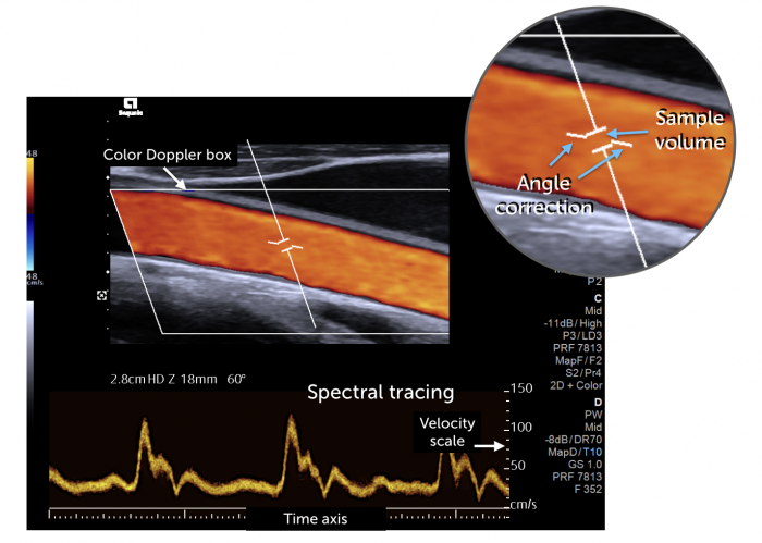 Spectral Doppler | 123sonography